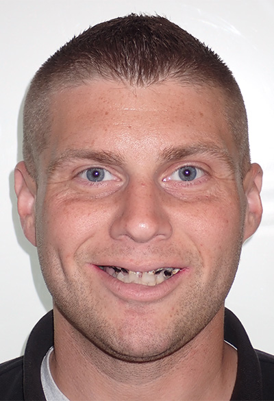 B&A-Face-Adam-Before B&A-Face-Adam-Before