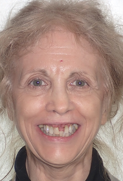 B&A-Face-Alex-Before B&A-Face-Alex-Before