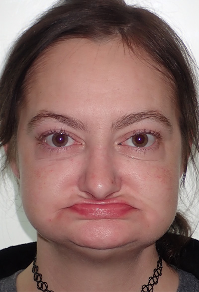 B&A-Face-Amanda-Before B&A-Face-Amanda-Before
