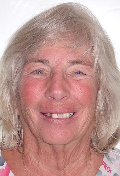 B&A-Face-Ann-Before B&A-Face-Ann-Before