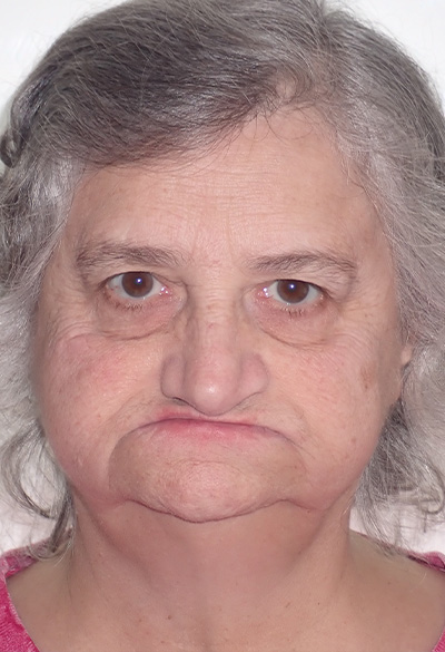 B&A-Face-Barb-Before B&A-Face-Barb-Before