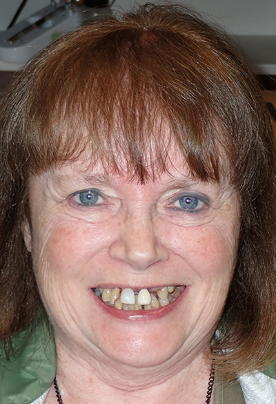 B&A-Face-Cheryl 2-Before B&A-Face-Cheryl 2-Before