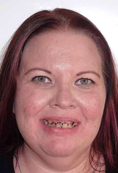 B&A-Face-Jessica-Before B&A-Face-Jessica-Before
