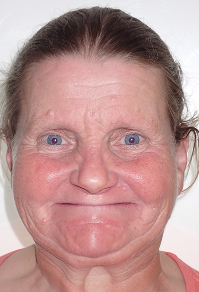 B&A-Face-Kathleen-Before B&A-Face-Kathleen-Before