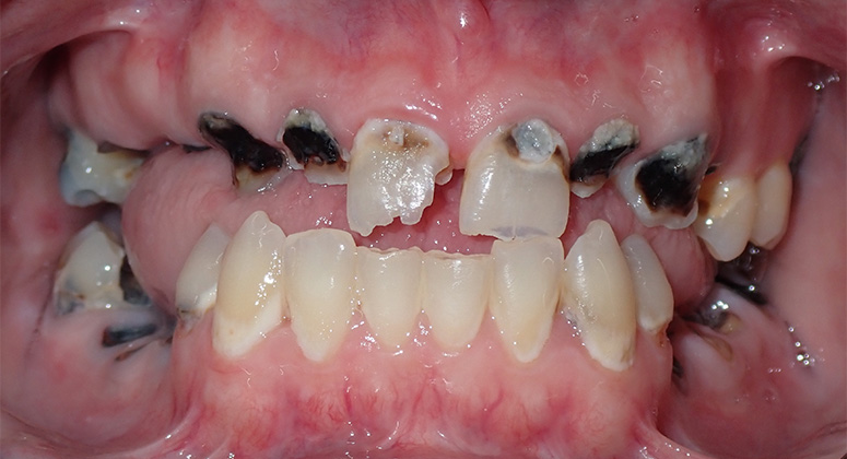 B&A-Teeth-Adam-Before B&A-Teeth-Adam-Before