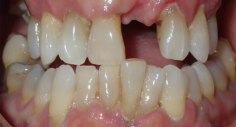 B&A-Teeth-Alex-Before B&A-Teeth-Alex-Before