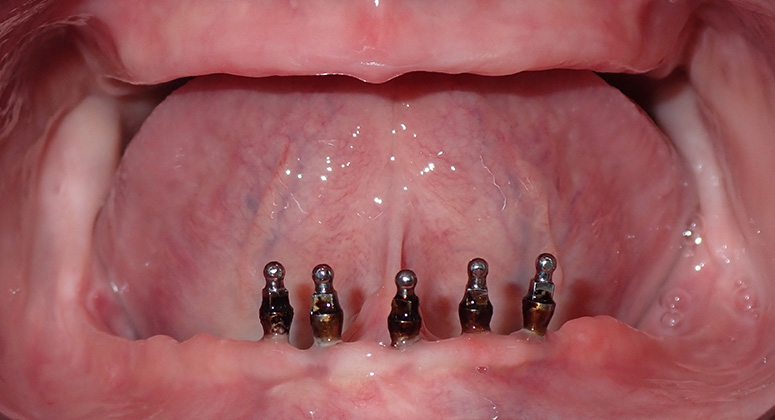 B&A-Teeth-Amanda 2-Before B&A-Teeth-Amanda 2-Before
