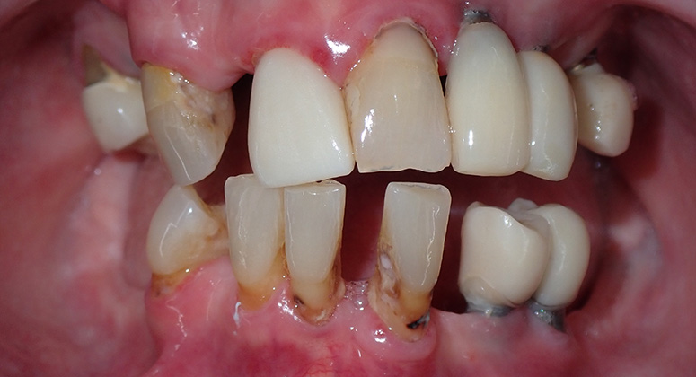 B&A-Teeth-Ann-Before B&A-Teeth-Ann-Before