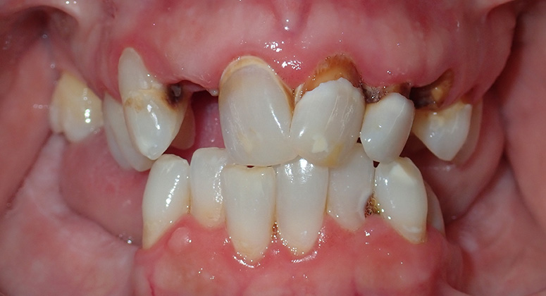 B&A-Teeth-Beth-Before B&A-Teeth-Beth-Before