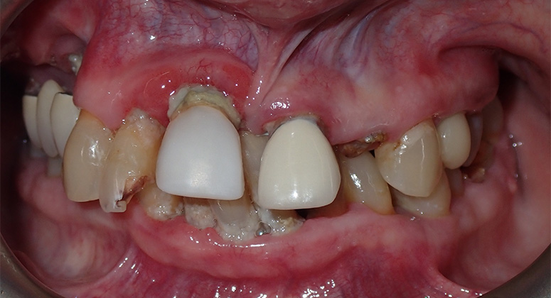 B&A-Teeth-Chery 2-Before B&A-Teeth-Chery 2-Before