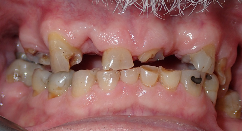 B&A-Teeth-Dave 3-Before B&A-Teeth-Dave 3-Before