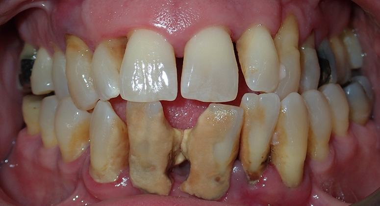 B&A-Teeth-James-Before B&A-Teeth-James-Before