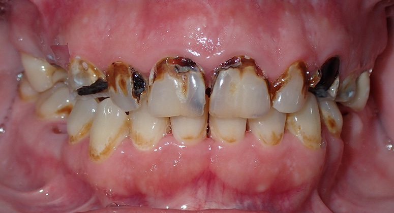 B&A-Teeth-Jessica-Before B&A-Teeth-Jessica-Before