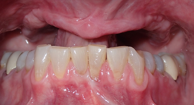 B&A-Teeth-Kathleen-Before B&A-Teeth-Kathleen-Before