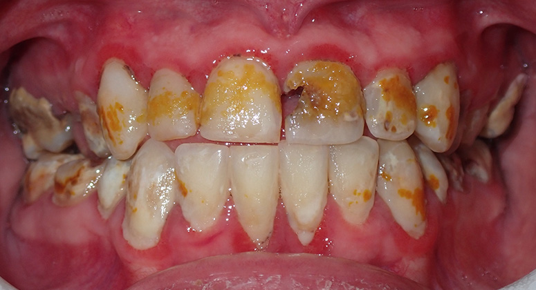 B&A-Teeth-Mason-Before B&A-Teeth-Mason-Before