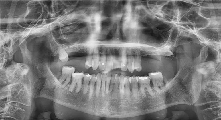 B&A-Teeth-Xray-Alex-Before B&A-Teeth-Xray-Alex-Before
