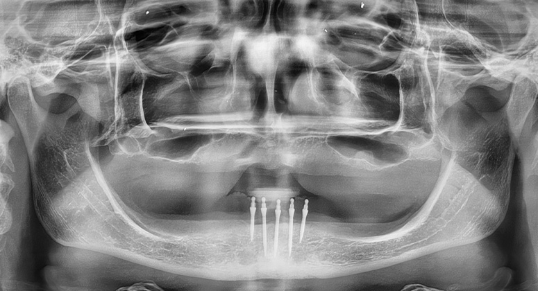 B&A-Teeth-Xray-Amanda 2-Before B&A-Teeth-Xray-Amanda 2-Before