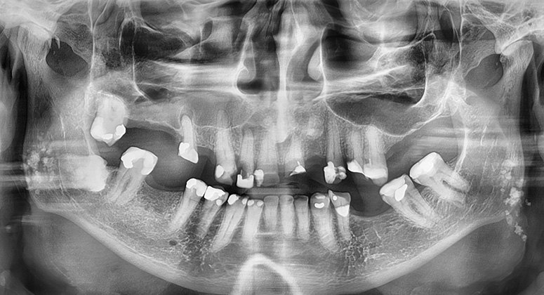 B&A-Teeth-Xray-Dave 3-Before B&A-Teeth-Xray-Dave 3-Before