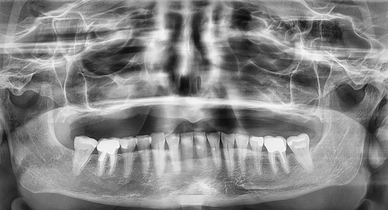 B&A-Teeth-Xray-Kathleen-Before B&A-Teeth-Xray-Kathleen-Before