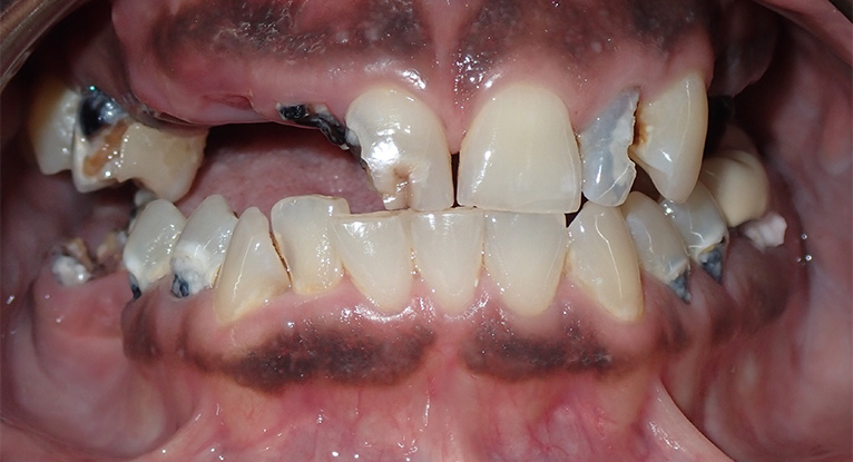 Dawn-teeth-before Dawn-teeth-before
