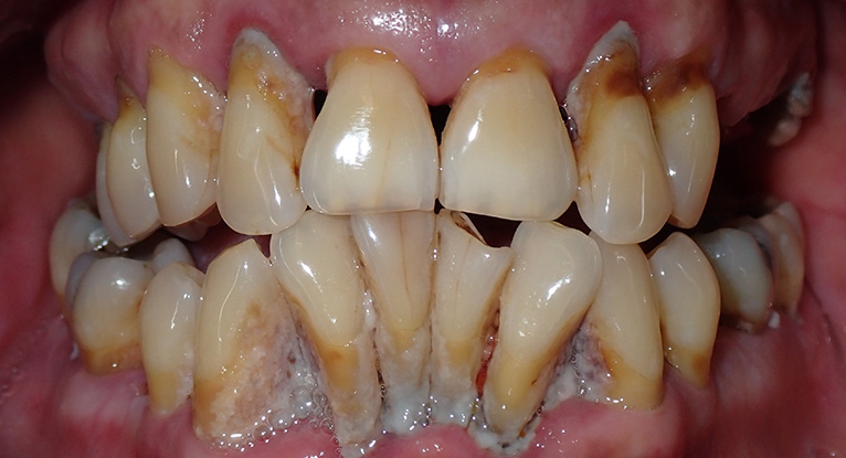 Richard-teeth-before Richard-teeth-before