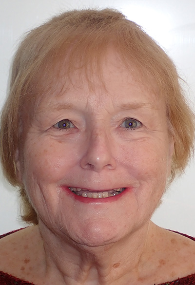 B&A-Face-Pat-Before B&A-Face-Pat-Before