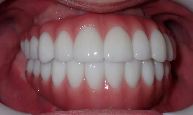 Dental Implants - Dr Kaplansky
